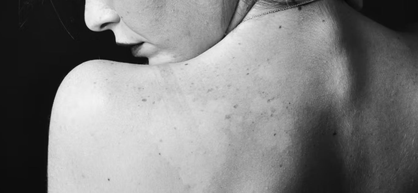 Ressecamento vaginal durante o tratamento oncológico - Feel